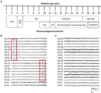 Case report: Marked electroclinical improvement by fluoxetine treatment in a patient with KCNT1-related drug-resistant focal epilepsy